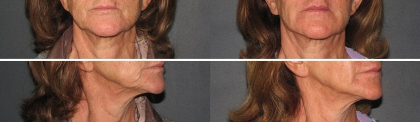 Remise en tension du dessin de l'ovale du visage par injections d'acide hyaluronique