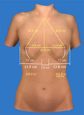 Mesures en 3d pour la simulation d'une augmentation mammaire par prothèses