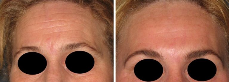 Avant / après injection de Botox sur le front et les pattes d'oie avec remodelage des tempes