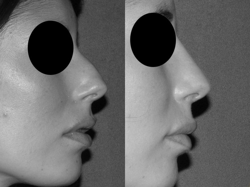 Photo avant / après de chirurgie esthétique du nez (rhinoplastie) réalisée par le Dr Niforos à Lyon