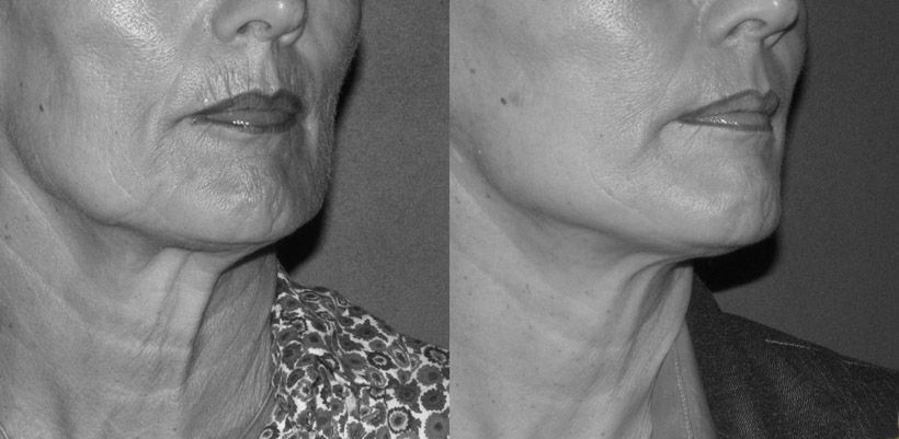 Photo avant / après de lifting cervico facial par le Dr Niforos