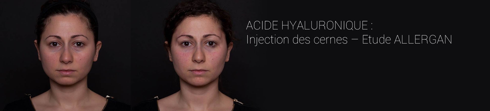 Image avant/après issue de l'étude Allergan sur l'injection d'Acide Hyaluronique pour réduire les cernes.