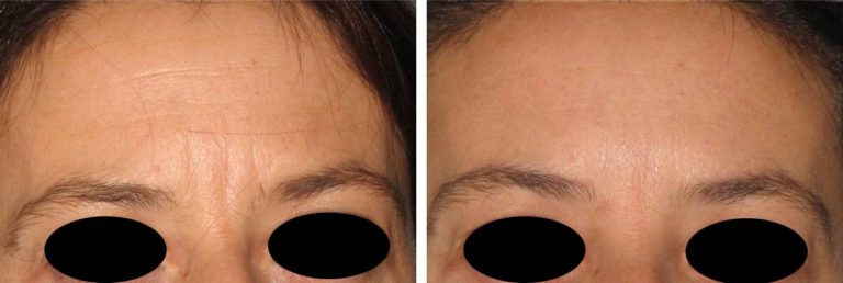 Traitement des rides du lion par injection de Botox