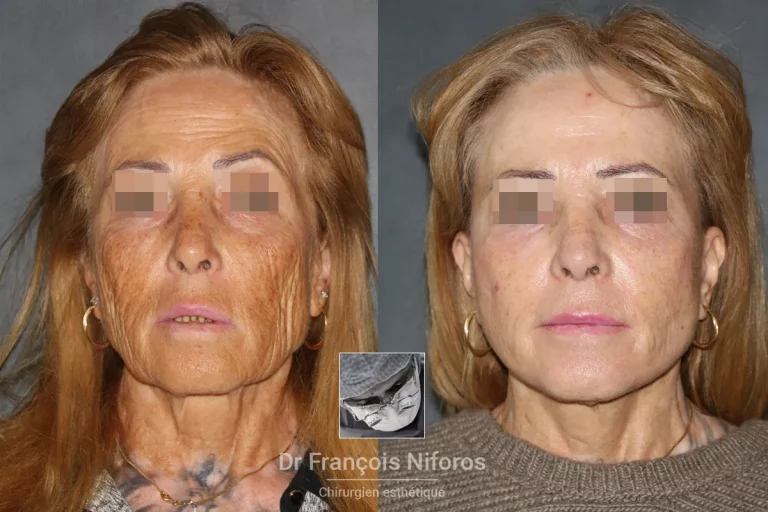 Photo de lifting cervico-facial avant / après