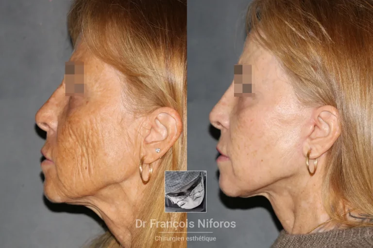 Photo de lifting cervico-facial avant / après