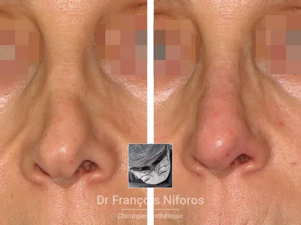 Photo avant après de rhinoplastie médicale réalisée par le Dr Niforos