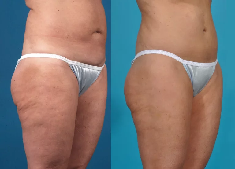 Liposuccion sans chirurgie par protocole BodyTite Morpheus 8