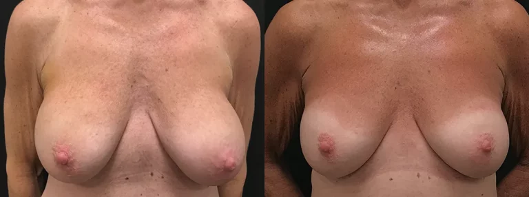 Lifting des seins sans chirurgie par protocole BodyTite Morpheus 8