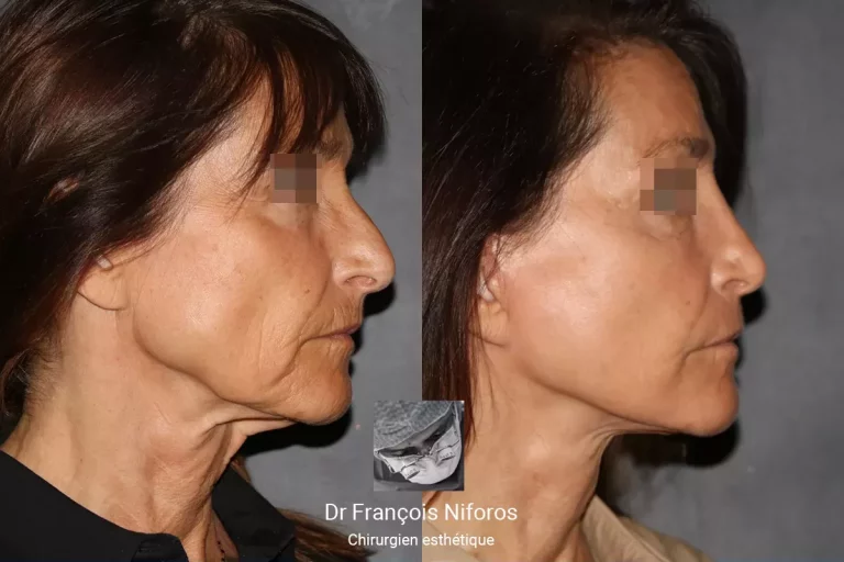 Photo avant / après de rhinoplastie et lifting réalisés par le Dr Niforos (vue de profil)