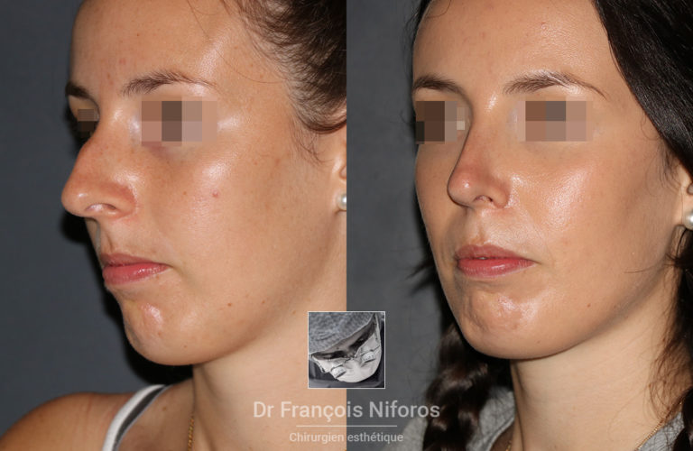 Rhinoplastie avant / après réalisée par le Dr Niforos (vue de trois quart)