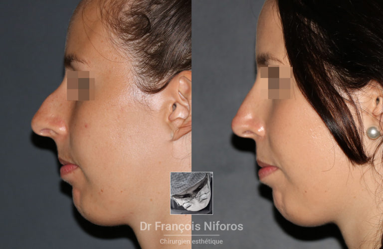 Rhinoplastie avant / après réalisée par le Dr Niforos (vue de profil)