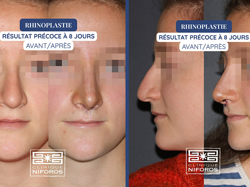 Photo avant / après de rhinoplastie conservatrice ultrasonique réalisée par le Dr Niforos