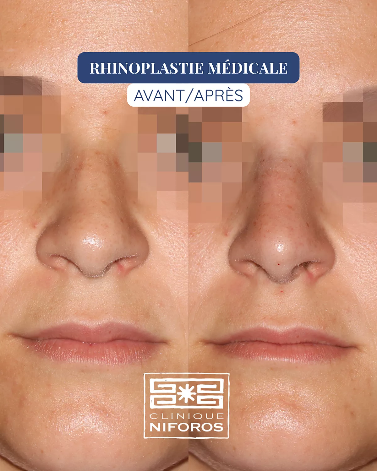 Photo avant après de rhinoplastie médicale réalisée par le Dr Niforos