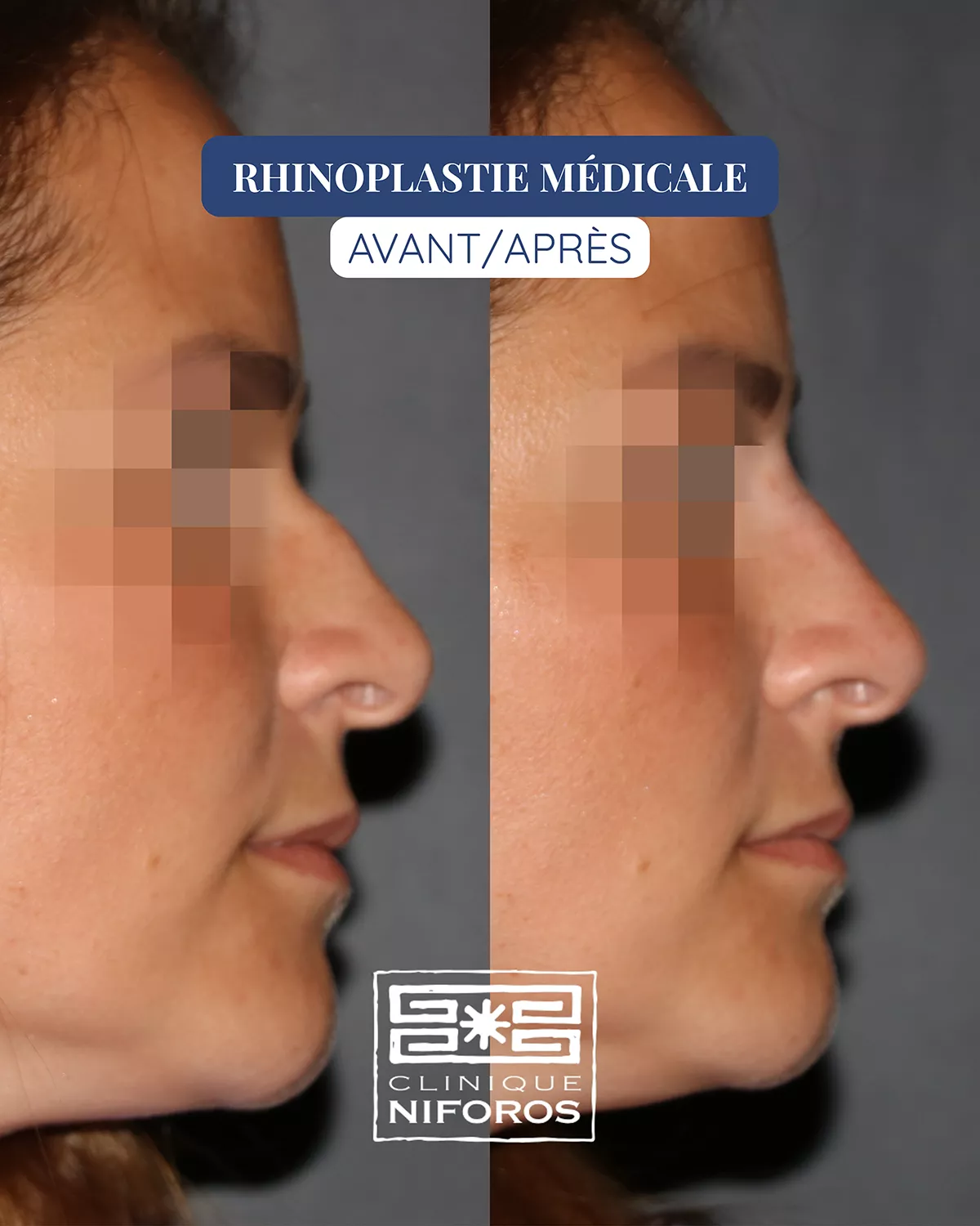 Photo avant après de rhinoplastie médicale réalisée par le Dr Niforos