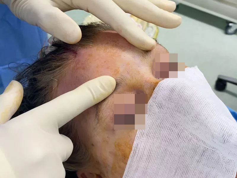 Endoscopie fronto-temporale réalisée par le Dr Niforos au bloc opératoire