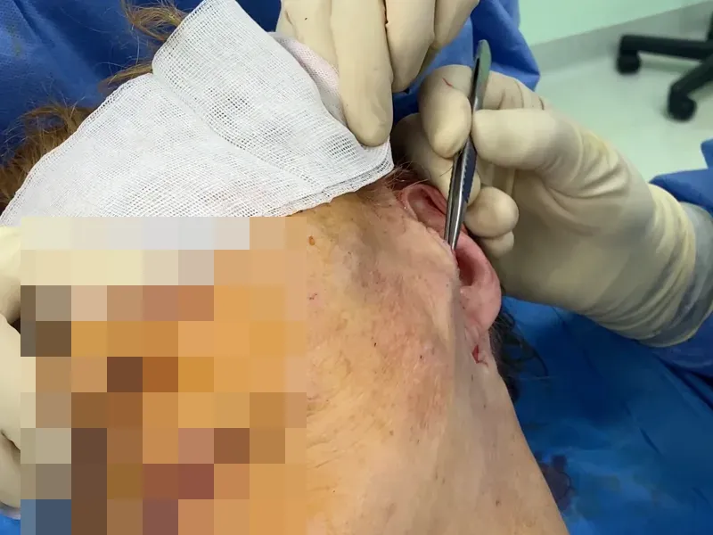 Le Dr Niforos réalise un lifting cervico-facial au bloc opératoire