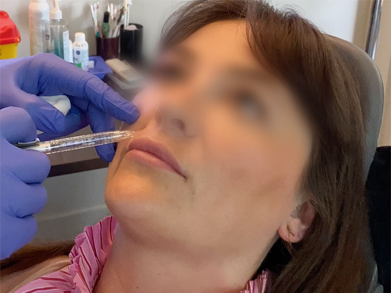 Le Dr Niforos injecte de l'acide hyaluronique dans les sillons nasogéniens d'une patiente