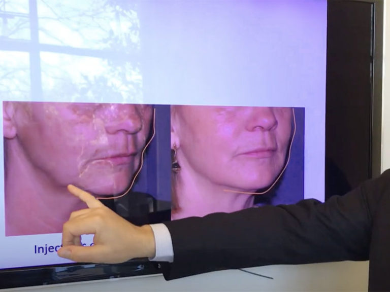 Présentation de l'injection d'acide hyaluronique dans l'ovale du visage