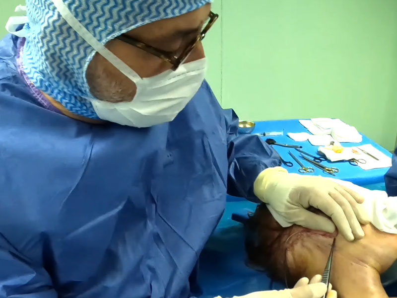 Le Dr Niforos réalise la reprise d'un lifting cervico-facial au bloc opératoire de la Clinique Niforos de Lyon
