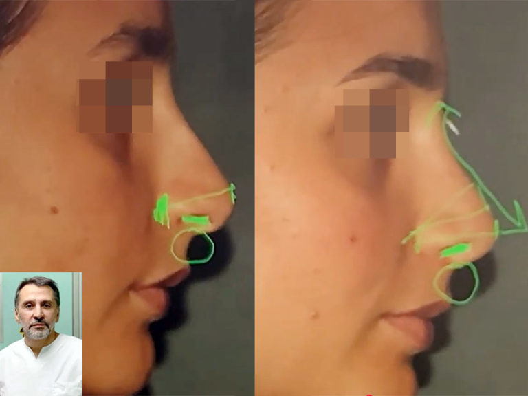 Photo avant / après de rhinoplastie d'un nez long chez une jeune femme