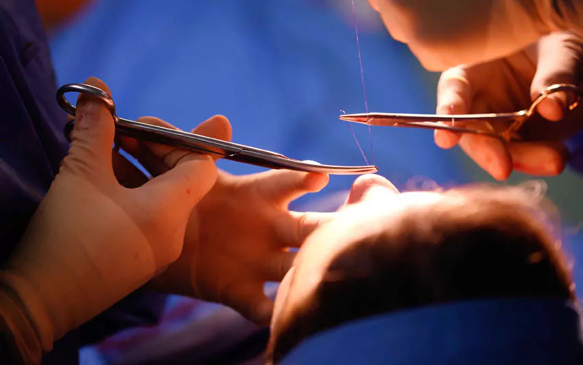Pose des fils de suture à la fin d'une intervention de rhinoplastie