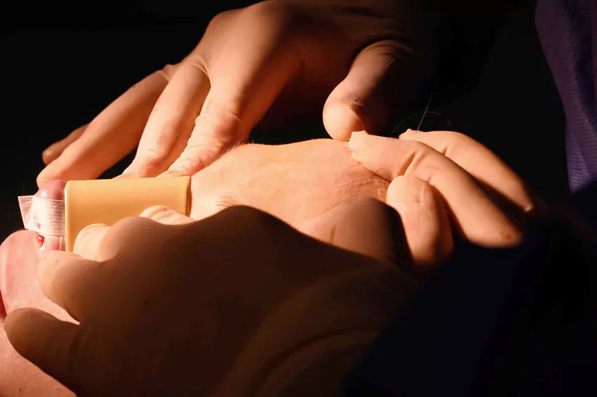 Pose d'une attelle sur le nez après une rhinoplastie