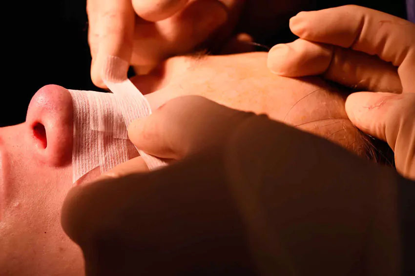 Pose du pansement après une intervention de rhinoplastie