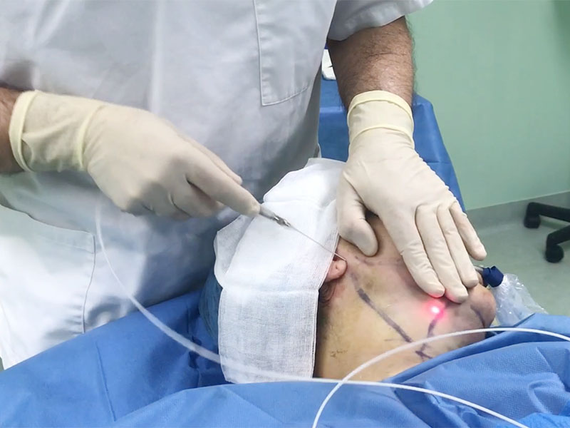 Traitement du double menton par endolaser à la clinique Niforos de Lyon