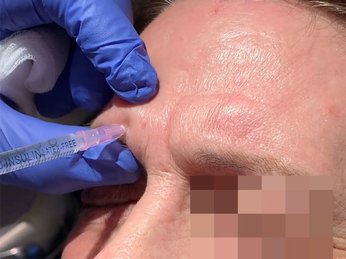 Corriger les rides du lion par injection de Botox et d'acide hyaluronique