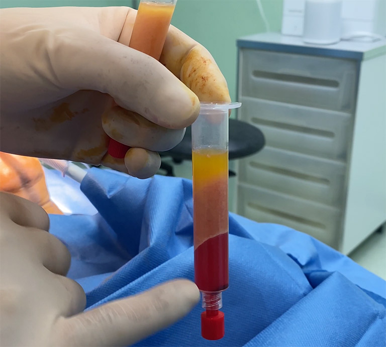 Graisse dans son flacon après centrifugation au bloc opératoire de la clinique Niforos