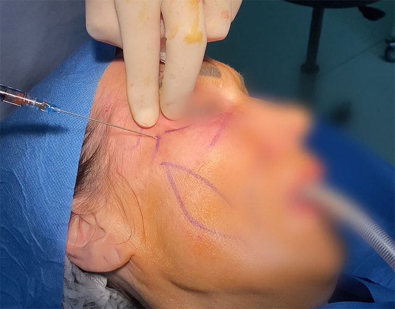 Le Dr Niforos injecte la graisse dans le visage de la patiente