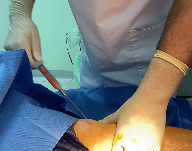 Le Dr Niforos au bloc opératoire prélève de la graisse au niveau de la cuisse d'une patiente en vue d'un lipofilling 