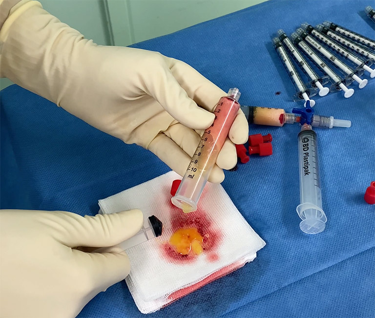 Séparation des fractions de graisses inutiles