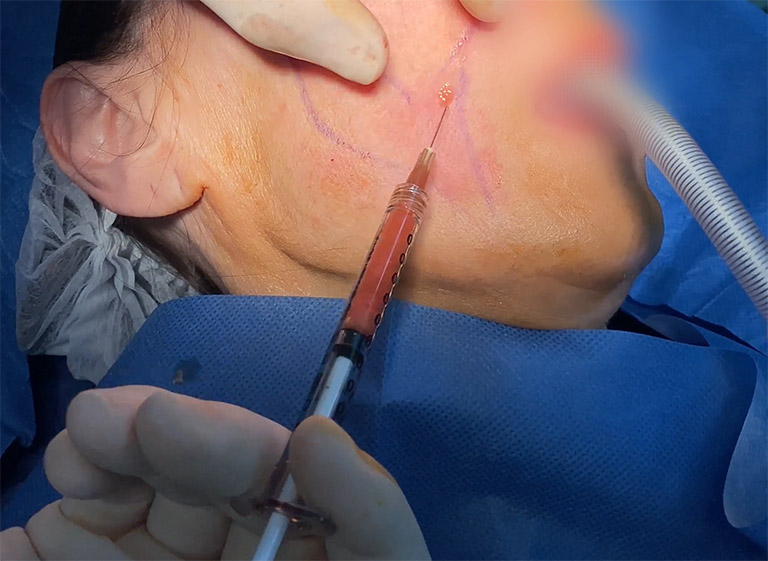 Injection de nanografting réalisée par le Dr Niforos