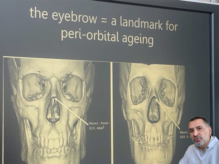 Vieillissement osseux montrant le changement du positionnement du sourcil
