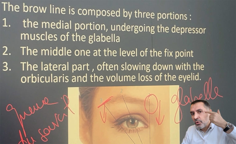 Zones concernées par la chirurgie des sourcils