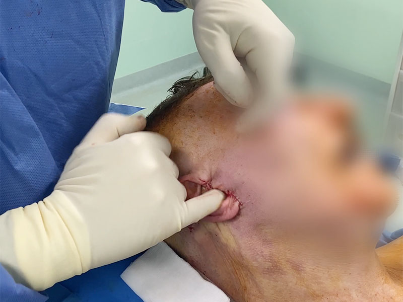 Lifting du visage masculin à cicatrices courtes réalisé par le Dr Niforos