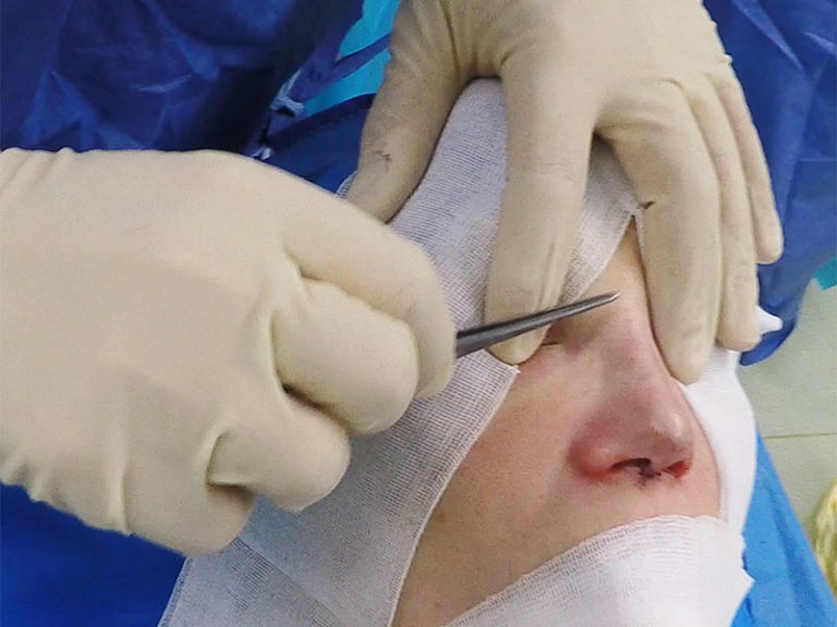 Rhinoplastie tertiaire par rhinosculpture au bloc opératoire de la clinique Niforos