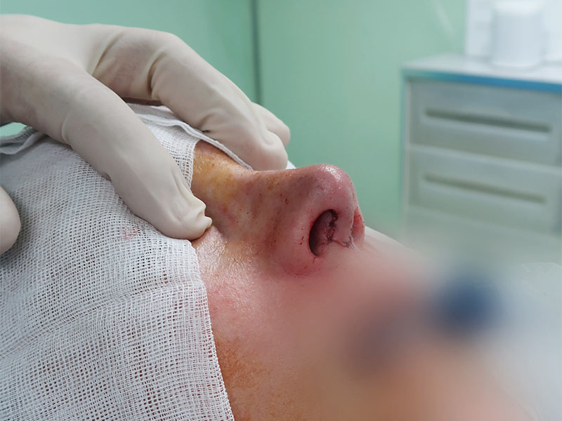 Plastie narinaire pour corriger une asymétrie